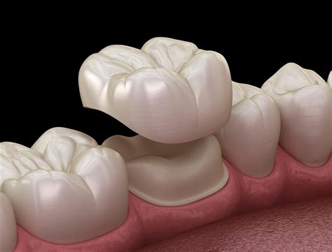Dental Crowns .